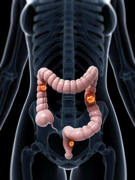 Rak jelita grubego: jakie są objawy i przyczyny tej śmiertelnej choroby?