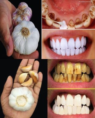 Tajemnica, której dentyści nie chcą ujawnić: jak szybko usunąć kamień nazębny i wybielić zęby w domu!