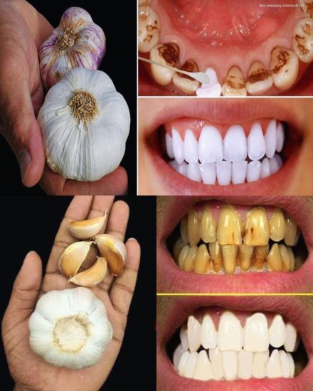 Tajemnica, której dentyści nie chcą ujawnić: jak szybko usunąć kamień nazębny i wybielić zęby w domu!